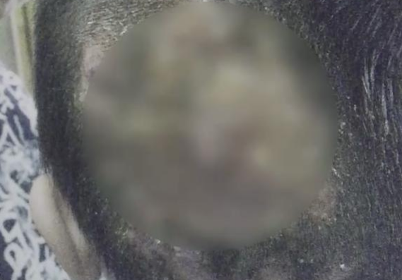 女孩养猫后满头脓包 医生：真菌感染恐永久脱发