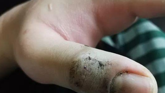 又把银环蛇当宠物！在浙江打工的19岁小伙嘴巴被咬，呼吸衰竭
