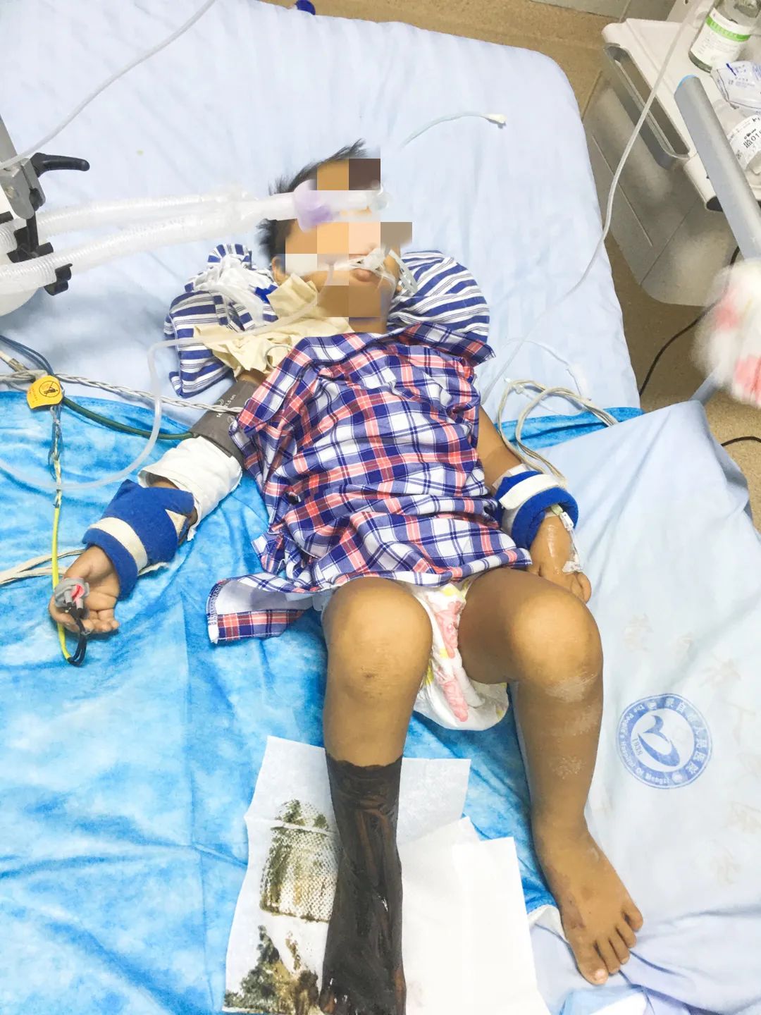 男孩被银环蛇咬伤急转蒙自救治,幸好…… 男孩被银环蛇咬伤急转蒙自救治,幸好……