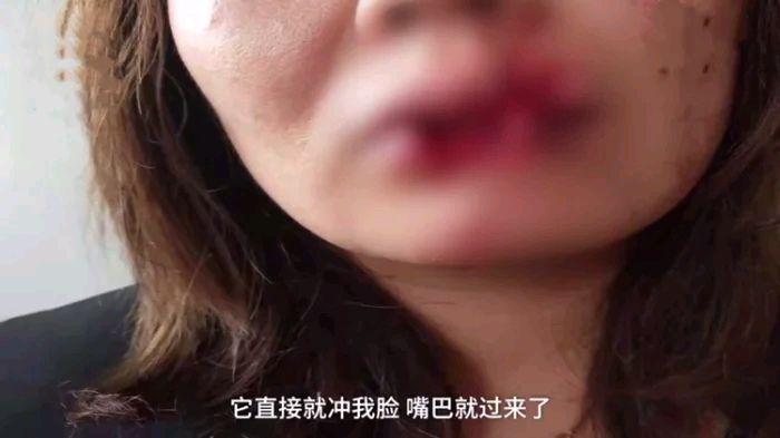 女子给朋友狗喂食，嘴唇被咬掉一半，医生：咬掉那一半找不到，已经没有办法复