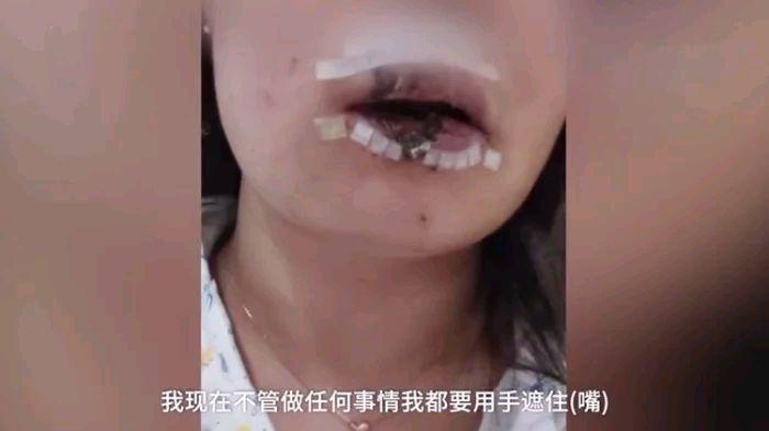 女子给朋友狗喂食,嘴唇被咬掉一半,医生:咬掉那一半找不到,已经没有办法复 女子给朋友狗喂食,嘴唇被咬掉一半,医生:咬掉那一半找不到,已经没有办法复