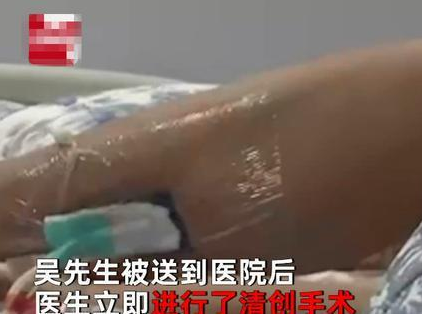 小猫偷吃东西，男子打它一下反被咬，小腿感染肿得像气球