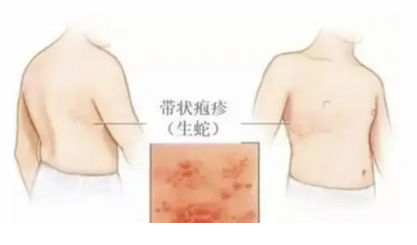 缠腰蛇哪里治疗最好 缠腰蛇哪里治疗最好