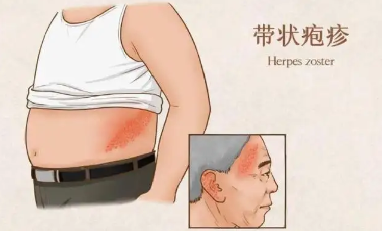 蛇缠颈是什么症状 蛇缠颈是什么症状