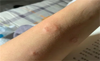 人得猫癣不治疗自己会痊愈吗
