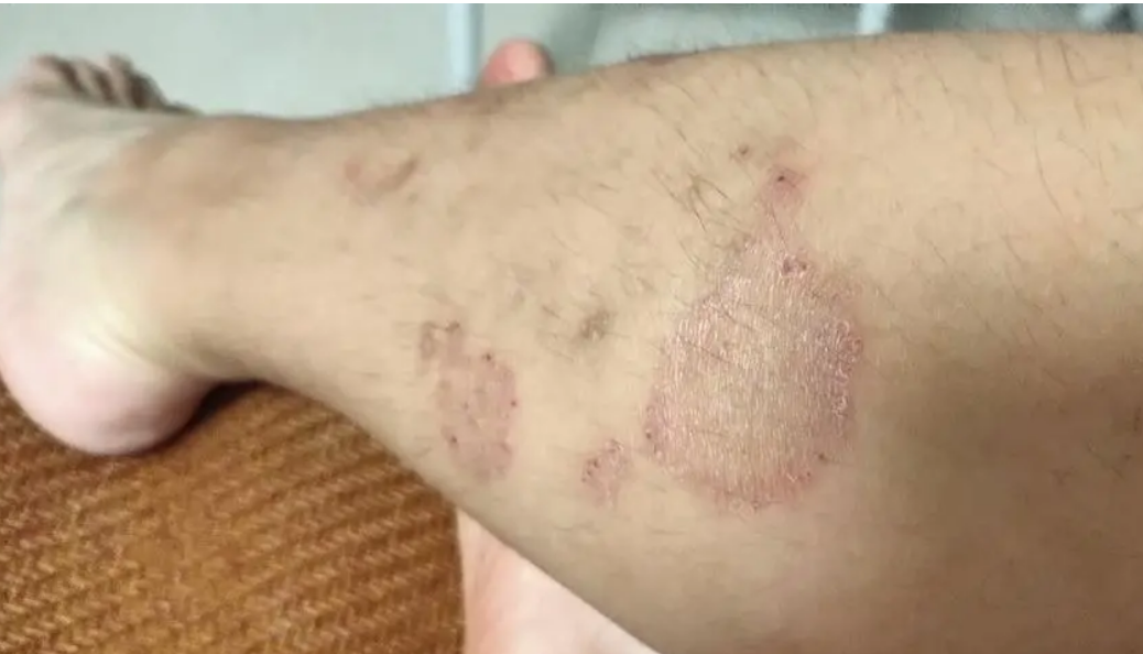 猫得了猫癣能自愈吗 猫得了猫癣能自愈吗