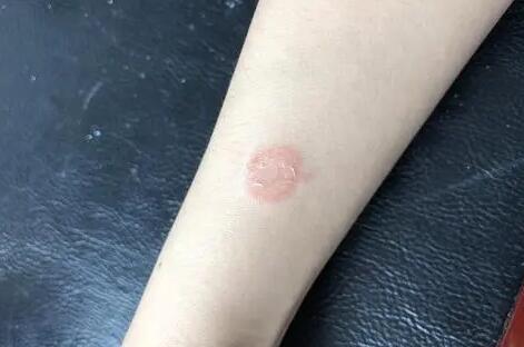 人得猫癣不治疗会自己痊愈吗
