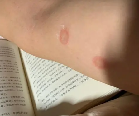 人得猫癣不治疗可以自己痊愈吗