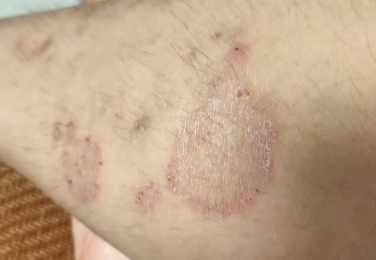 人得猫癣一般多久会好