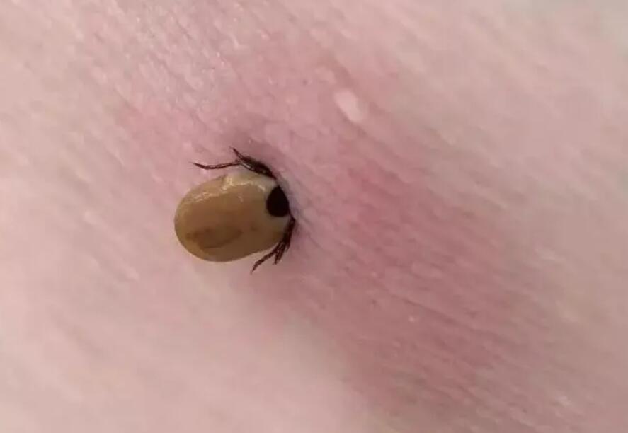人身上长满蜱虫图片
