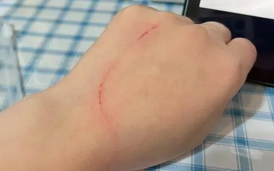 被自家猫抓伤了,需要打疫苗吗? 被自家猫抓伤了,需要打疫苗吗?