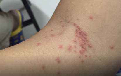 不同虫咬辨别 图片
