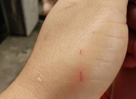 猫抓伤要不要打针