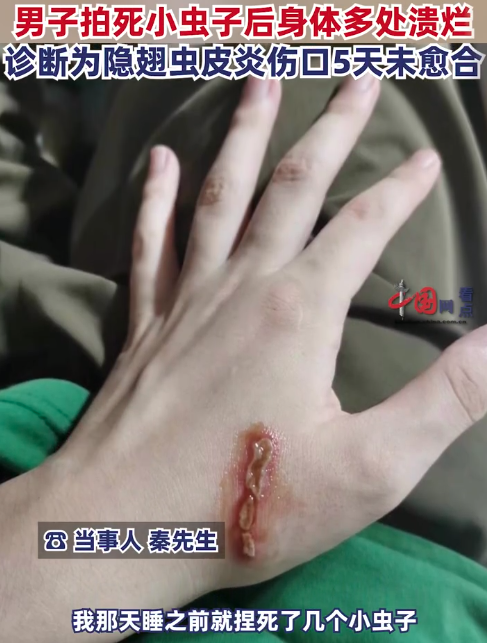 男子拍死隐翅虫多处溃烂5天未愈 身体出现多处红印