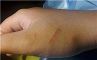 被猫抓后有什么症状啊
