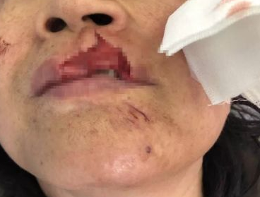 养了13年的秋田犬把天津大姐的嘴唇咬掉……家狗为何咬人？