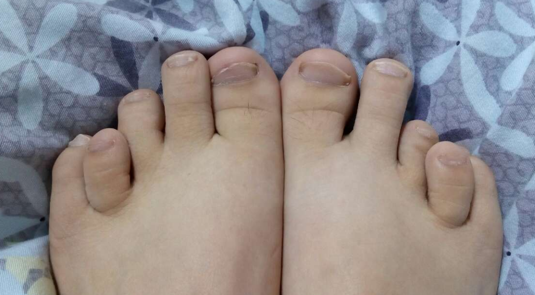 第4个脚趾畸形的人多吗