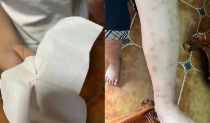 重庆一小区流浪猫死亡致跳蚤成灾，消杀无果，有孩子被咬满腿疙瘩！