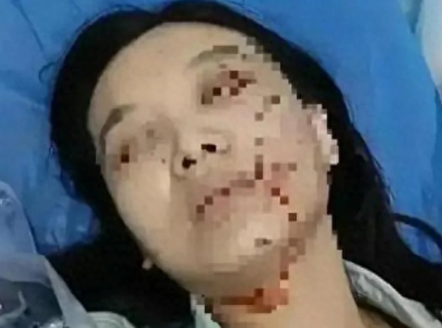 网曝江苏咬人狗已经离世，女子治疗费用高达百万，狗主人拒绝赔偿