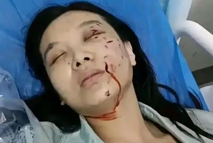 惨不忍睹!摸狗被咬后续,一只眼或失明,面部毁容! 惨不忍睹!摸狗被咬后续,一只眼或失明,面部毁容!