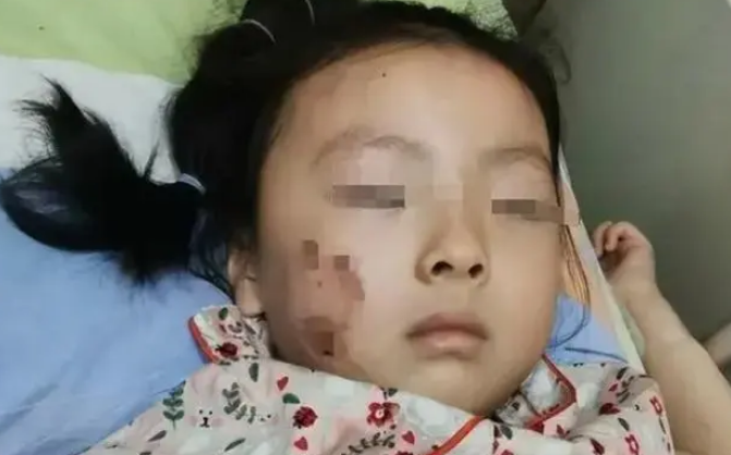 剩下的194万善款怎么办?被狗咬女童成功转出ICU,前后花费仅6万 剩下的194万善款怎么办?被狗咬女童成功转出ICU,前后花费仅6万
