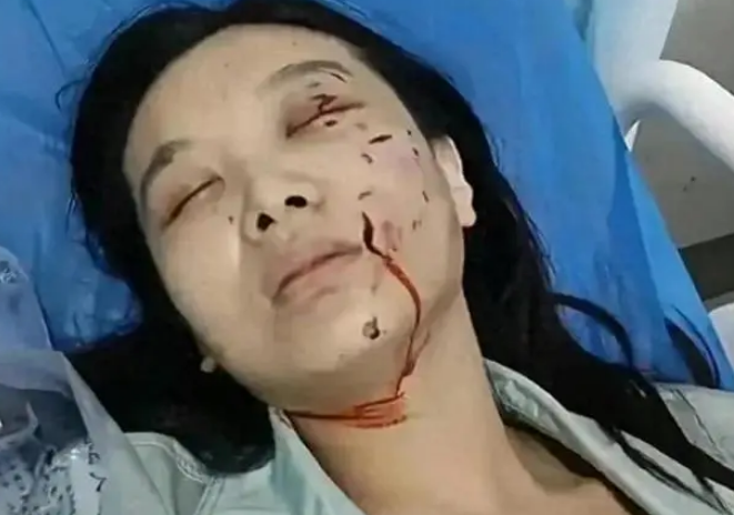 事件后续来了！摸狗被咬女子现已毁容，狗主人将面临巨额索赔