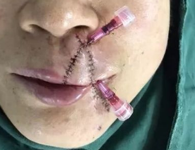 养了13年的秋田犬把天津大姐的嘴唇咬掉……家狗为何咬人？