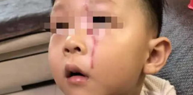 3岁男童被狗抓伤脸，狗主人谎称牵了绳不愿担责