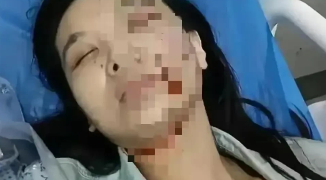 江苏被狗咬女子左眼恐失明,狗主人面临天价赔偿 江苏被狗咬女子左眼恐失明,狗主人面临天价赔偿