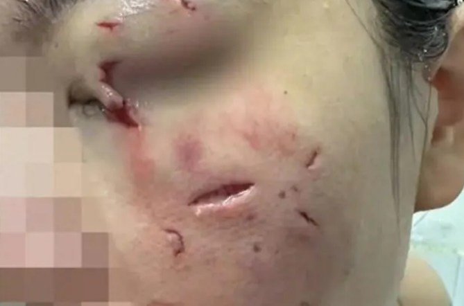 女子路边逗狗突遭撕咬满脸是血,狗主人:狗狗平常性格很好不咬人的,该赔偿的肯定会赔偿 女子路边逗狗突遭撕咬满脸是血,狗主人:狗狗平常性格很好不咬人的,该赔偿的肯定会赔偿
