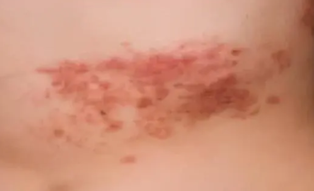 拦腰蛇的症状和图片