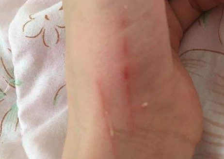 狗抓了一下有淡淡红痕 狗抓了一下有淡淡红痕