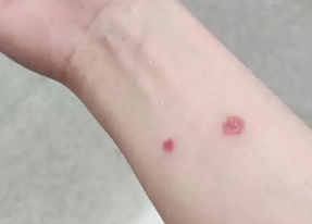 人长猫癣后会严重吗 人长猫癣后会严重吗
