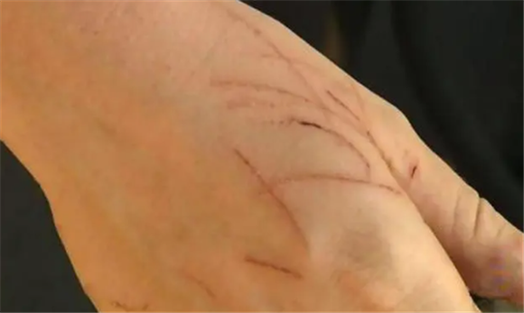有没有人被猫抓了死掉的