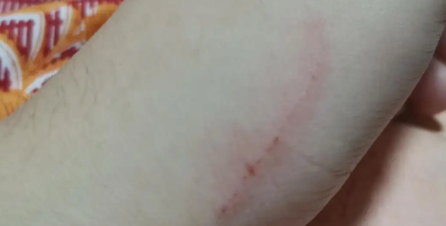 为什么很多人被猫抓了没事