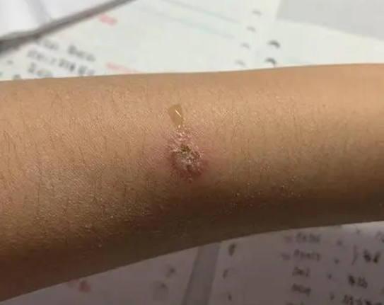 人感染了猫藓图片