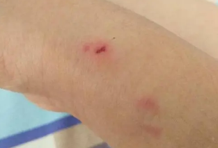 狗抓了一道印子要打针吗 狗抓了一道印子要打针吗