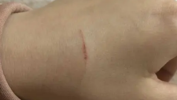 皮肤被猫轻微抓破了怎么办 皮肤被猫轻微抓破了怎么办