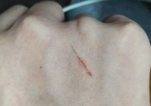 让猫挠了轻微出血有事吗