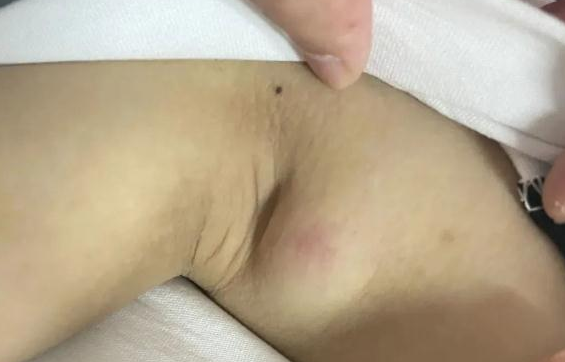 男子被猫抓伤后确诊“猫抓病”! 男子被猫抓伤后确诊“猫抓病”!