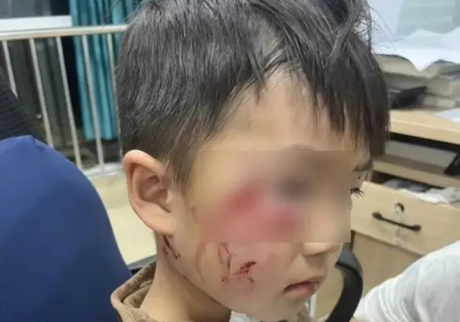 3岁男童被狗咬伤打了疫苗仍离世