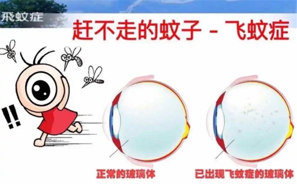 飞蚊症有光就有蚊子那吗