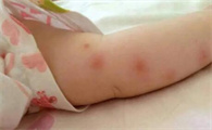 隔着裤子会被蚊子咬吗