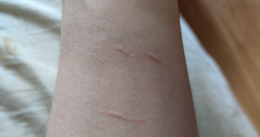 被猫抓了一下破皮没出血