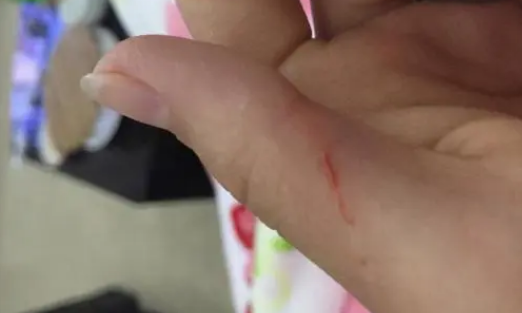 被猫抓伤的图片大全