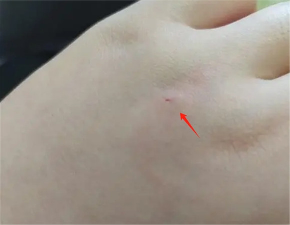 被猫抓了肉眼几乎看不到伤口 被猫抓了肉眼几乎看不到伤口