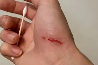 被猫抓了一下红色划痕鼓起来了