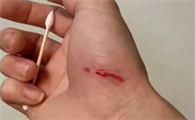 被猫抓了一下红色划痕鼓起来了