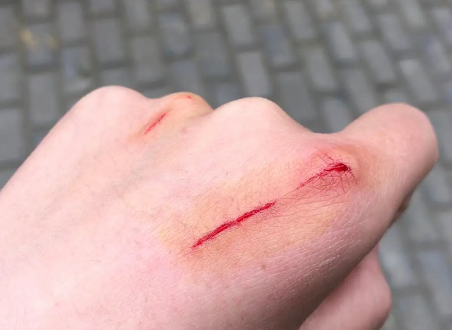 被猫抓后多大几率感染猫抓病