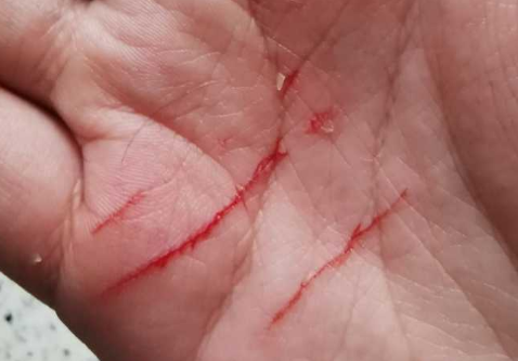被猫抓了一下轻微破皮没出血 被猫抓了一下轻微破皮没出血